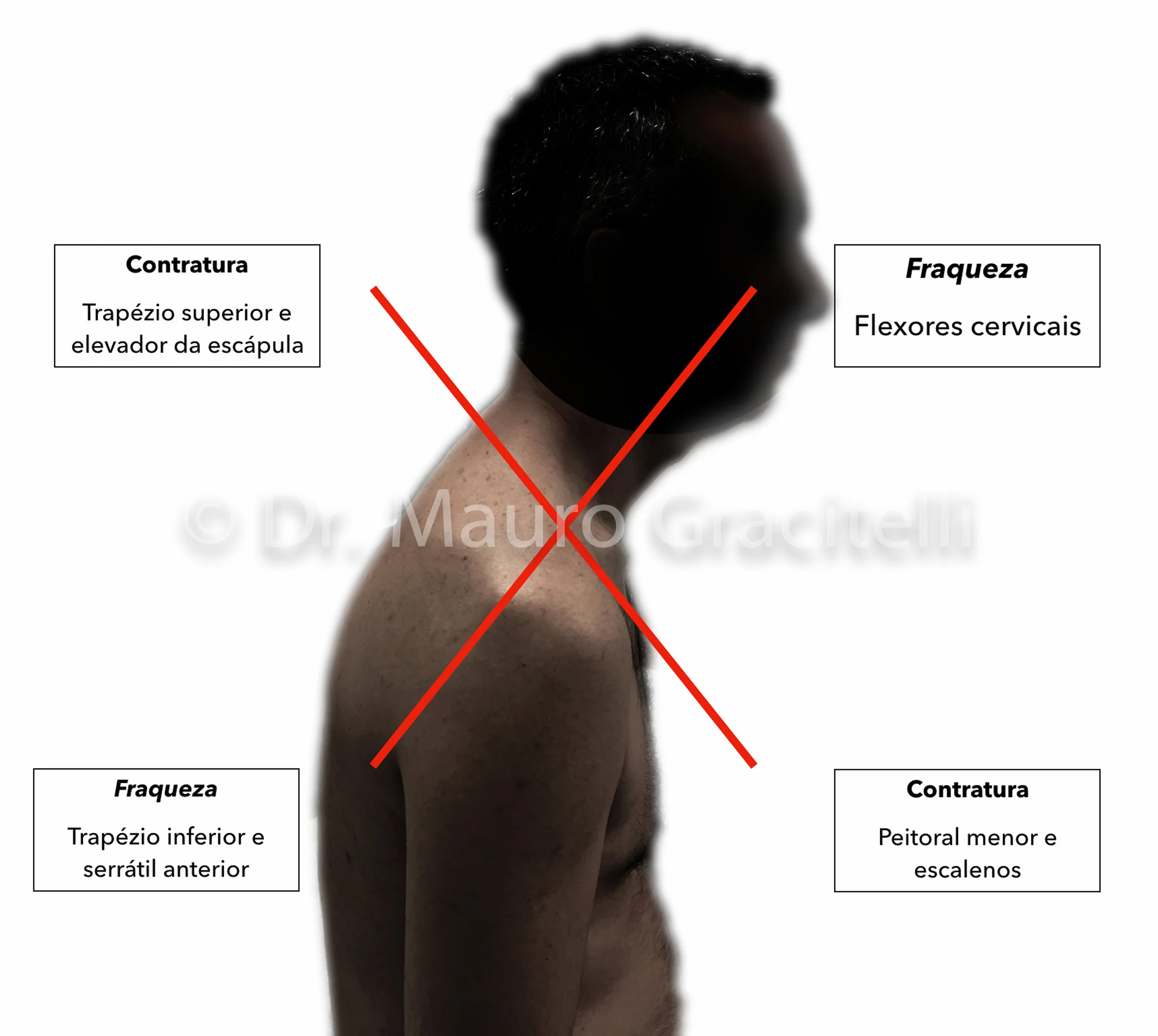 Postura-dor-ombro2-sindrome-cruzada-superior.jpg