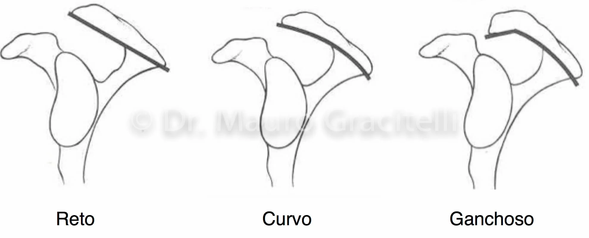 Diferente tipos de acrômio