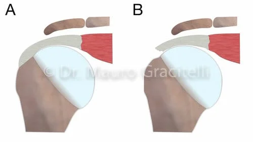 A: TENDÃO NORMAL; B: ROTURA COMPLETA SEM RETRAÇÃO