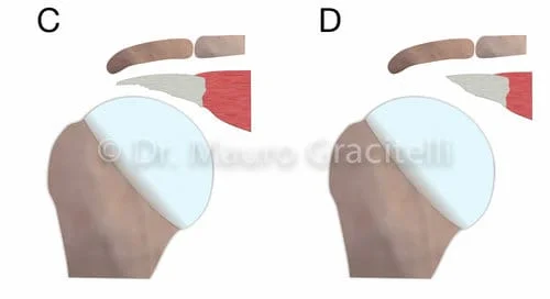 C: Rotura completa com retração; D: Rotura extensa