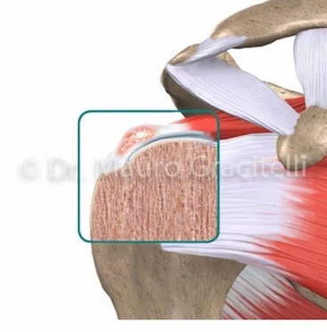 tendinite_calcaria01.jpg
