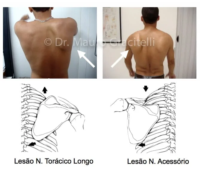 Tipos de escápula alada por lesão neurológica