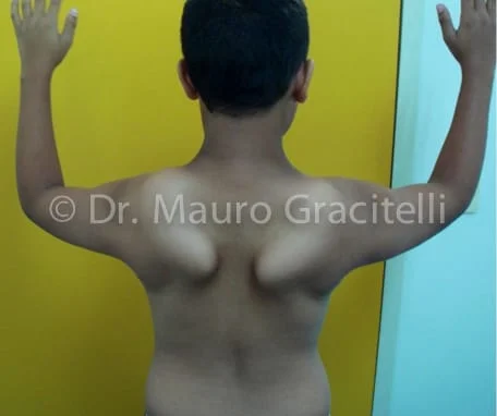 Escápula alada por distrofia fascioescapuloumeral