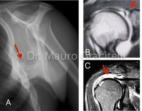 Causas secundárias de discinesia da escápula. A) Tumor benigno (osteocondroma) B) lesão SLAP c) lesão extensa do manguito rotador