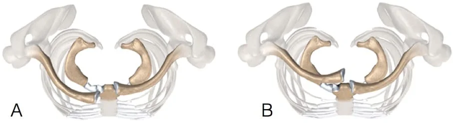 Direção da luxação esternoclavicular: A) anterior b) Posterior