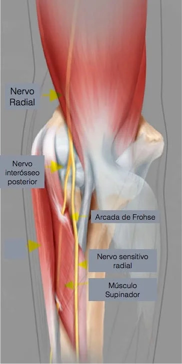 Trajeto do nervo radial no cotovelo e antebraço e locais de possível compressão