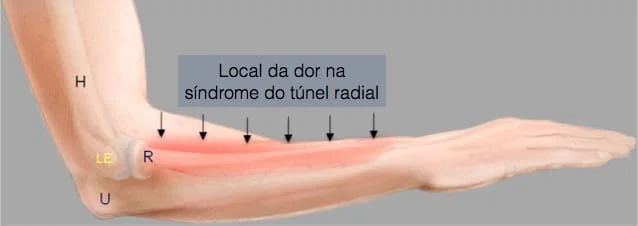 Local da dor na síndrome do túnel radial