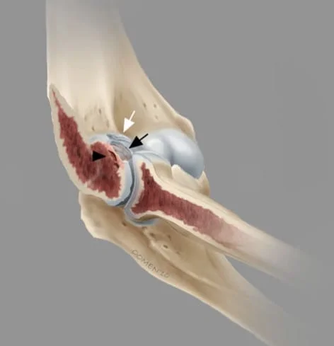 osteocondrite dissecante do cotovelo