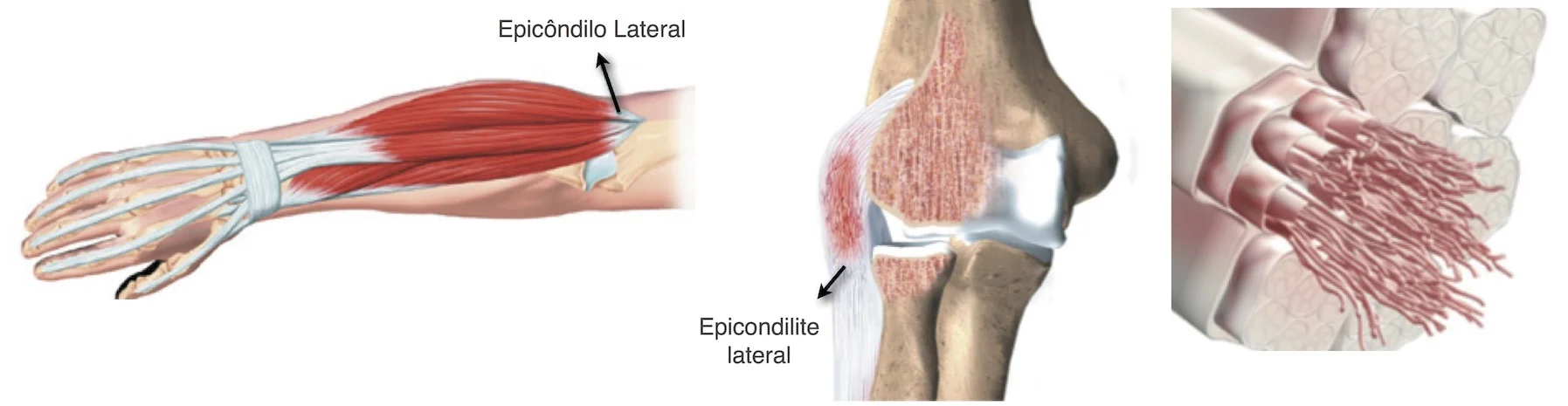 epicondilite_lateral_03.jpg