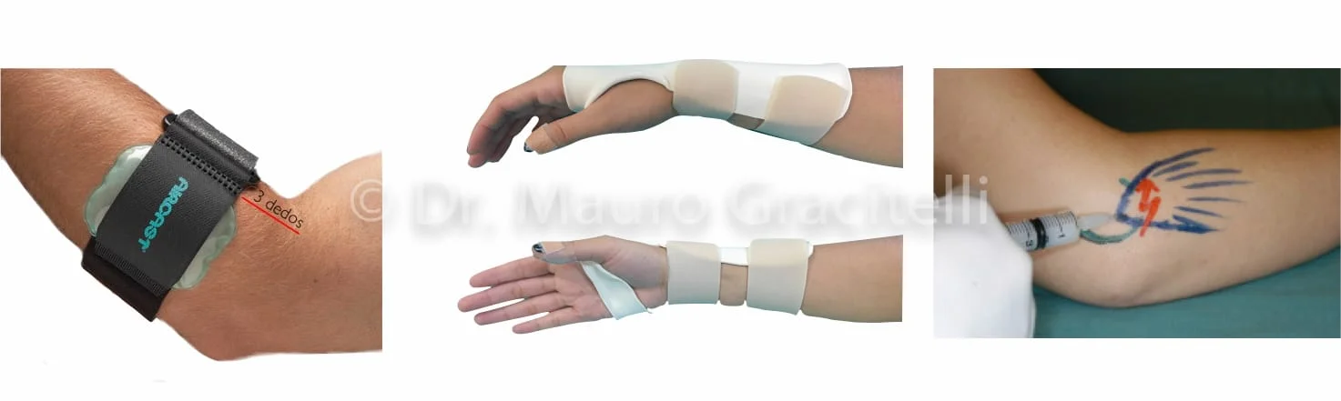 Imagem da esquerda: cinta para epicondilite lateral aircast. Imagem central: órtese dorsal de punho (IMAGEm FORNECIDA PELA EQUIPE DE TERAPIA OCUPACIONAL DO IOT HCFMUSP, SOB CHEFIA DA TERAPEUTA MARIA CÂNDIDA LUZO). imagem da direita: infiltração.