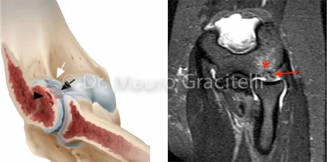 Lesão osteocondral do capítulo