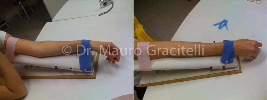 Alongamento do cotovelo para ganho de extensão, realizado de modo leve e progressivO