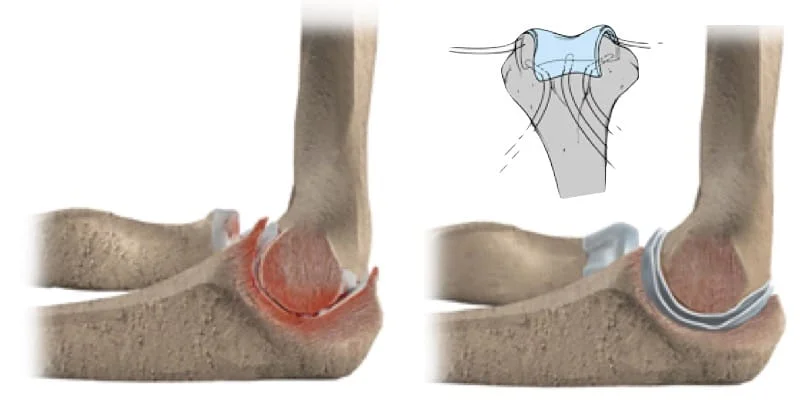 Ilustração da artroplastia de interposição