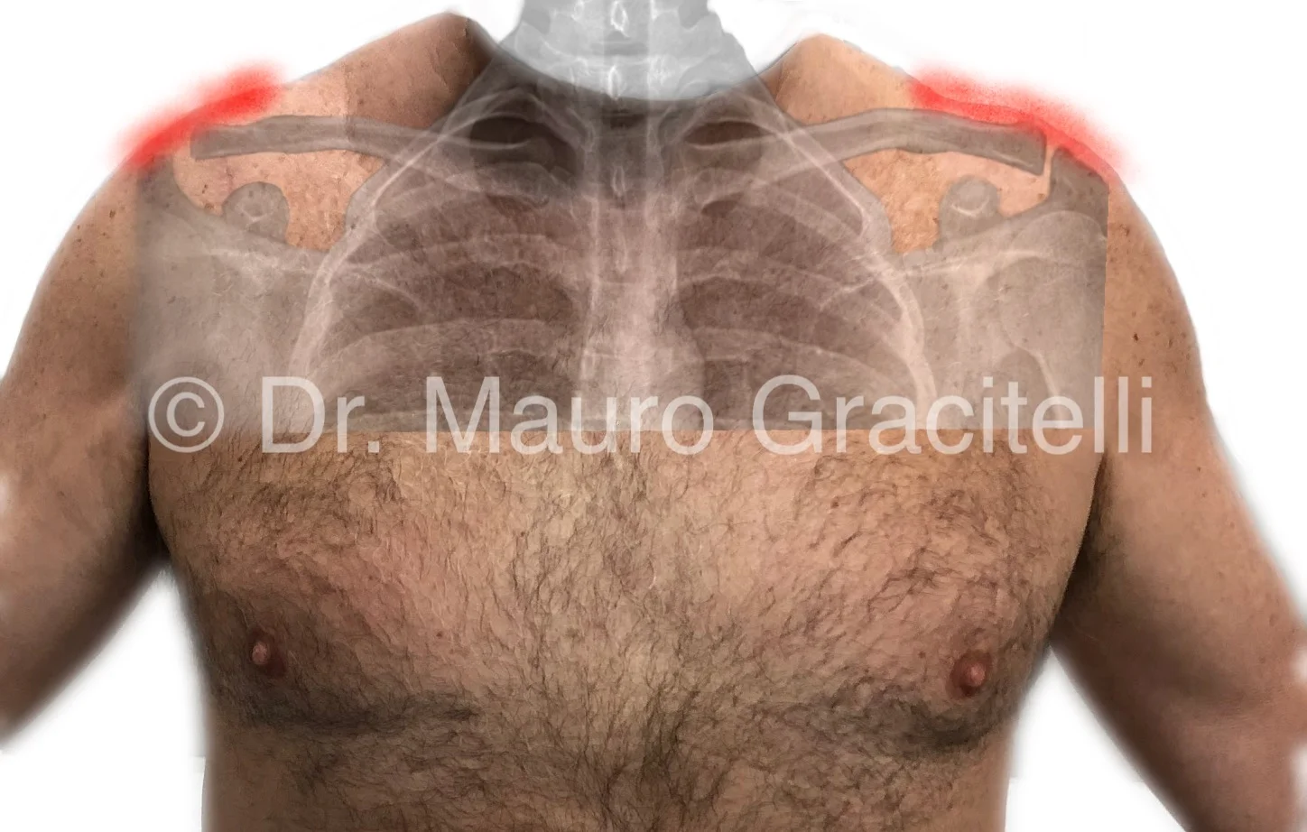 Artroseacromioclavicular_local da dor.jpg