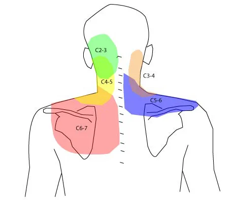 cervicalgia-dor-cervical-02.jpeg