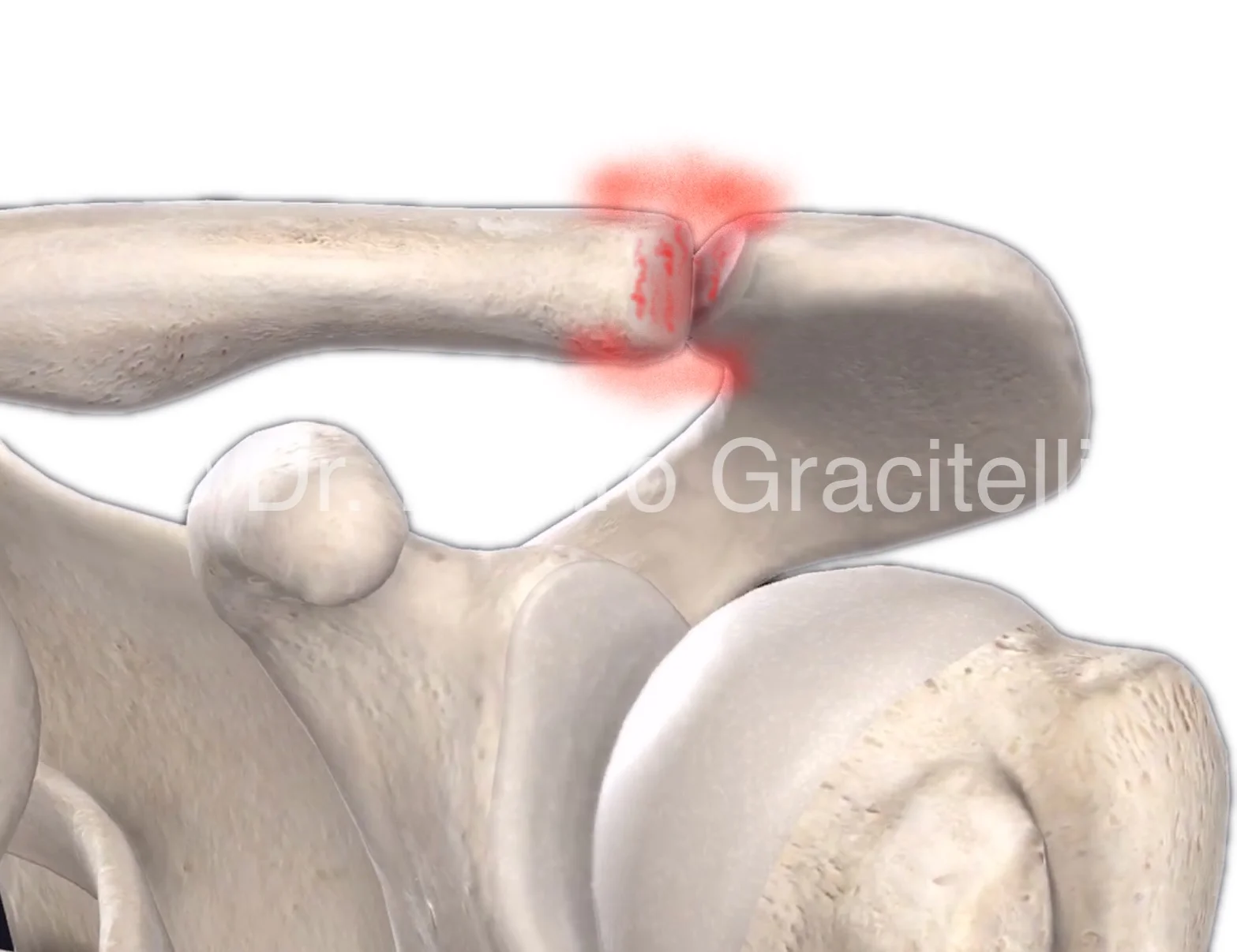 Artroseacromioclavicular_anatomia.jpeg