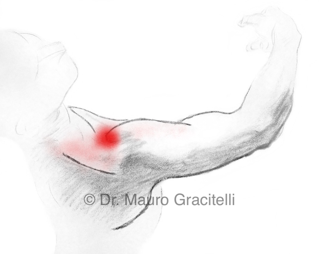 Local_Da_Dor_acromioclavicular.jpeg