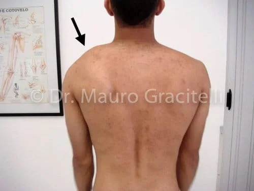 Discinesia de escápula (escápula alada)
