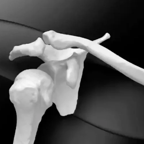 Luxação acromioclavicular