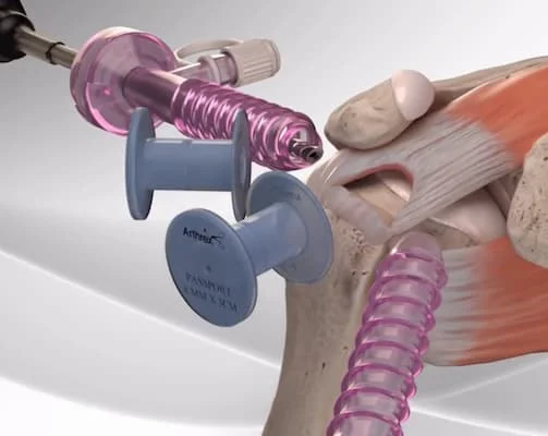 Cirurgia para reparação da lesão dos tendões do manguito rotador