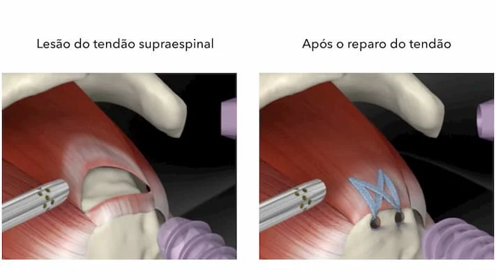 Exemplo de uma lesão do tendão supraespinal (figura da esquerda). Aspecto após a cirurgia por artroscopia para reparação do tendão.