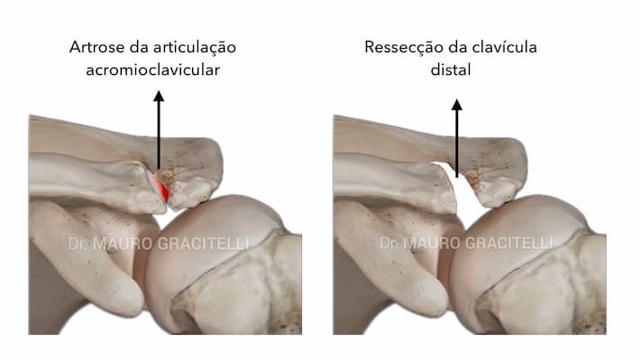 Resseccao-lateral-clavícula.jpeg