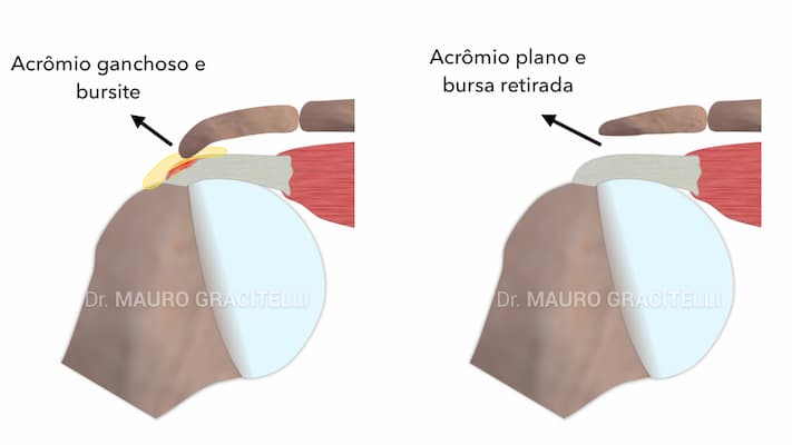 Acromioplastia-bursectomia.jpeg