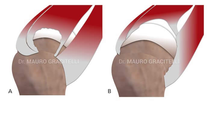 Diferentes tipos de lesão do manguito rotador. A) Lesão isolada de tamanho médio do supraespinal. B) Lesão extensa, com rotura do supra e infraespinal e subescapular.