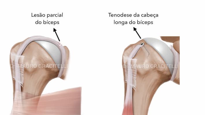 Tenodese-biceps.jpeg