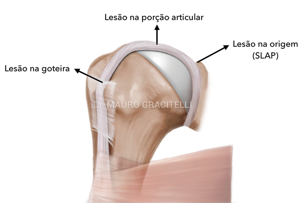 locais-lesao-biceps.png