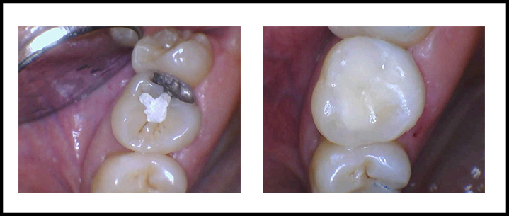 Amalgam Removal Before and After 1.jpg
