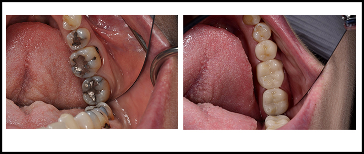 Amalgam Removal Before and After 2.jpg