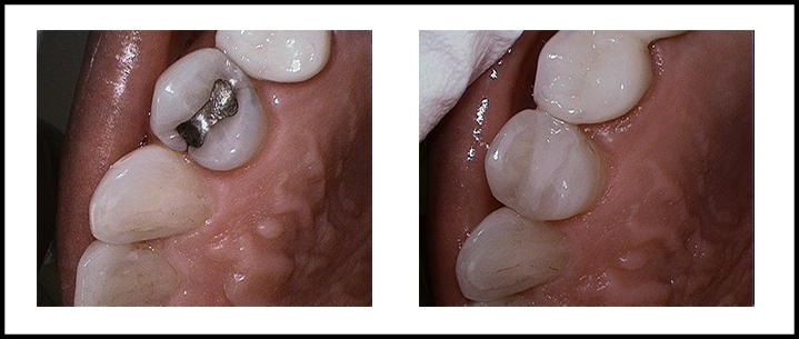 Amalgam Removal Before and After 3.jpg