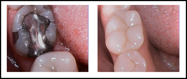 Amalgam Removal Before and After 4.jpg