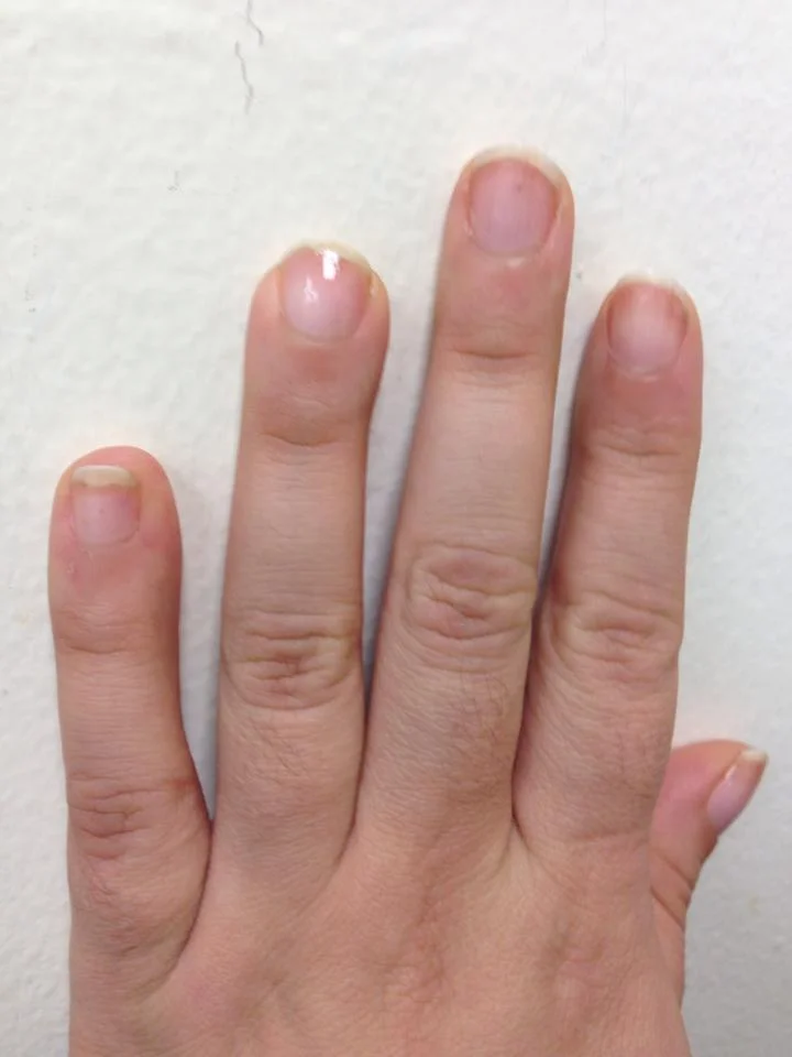 severed fingertip2.jpg