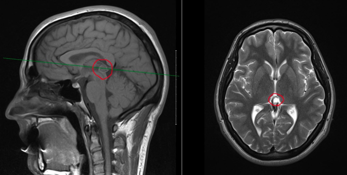 The pineal cyst in Evan's brain