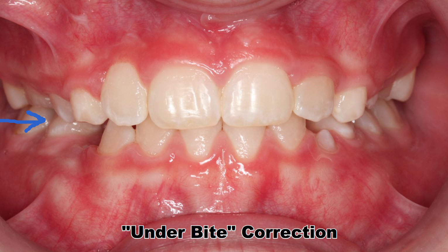 After Phase I Early Orthodontic Treatment the Under Bite is corrected.