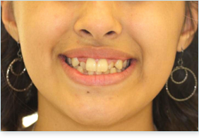 Before teen braces