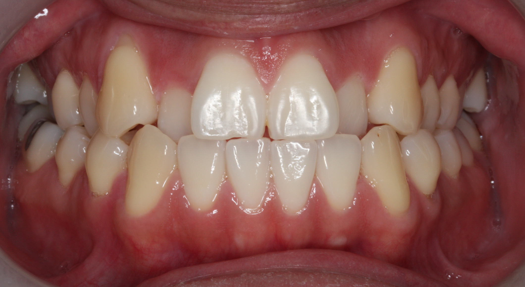 Anterior Crossbite