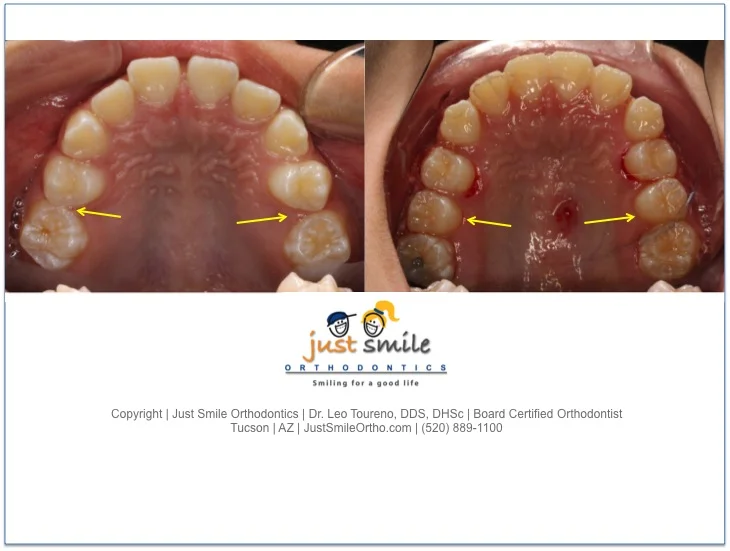 Phase 1 Orthodontic Treatment