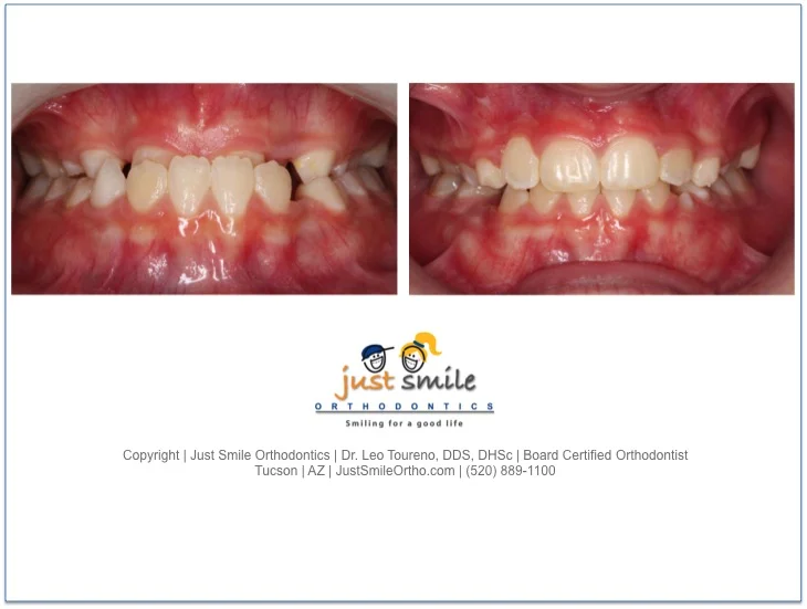 Phase 1 Underbite Correction