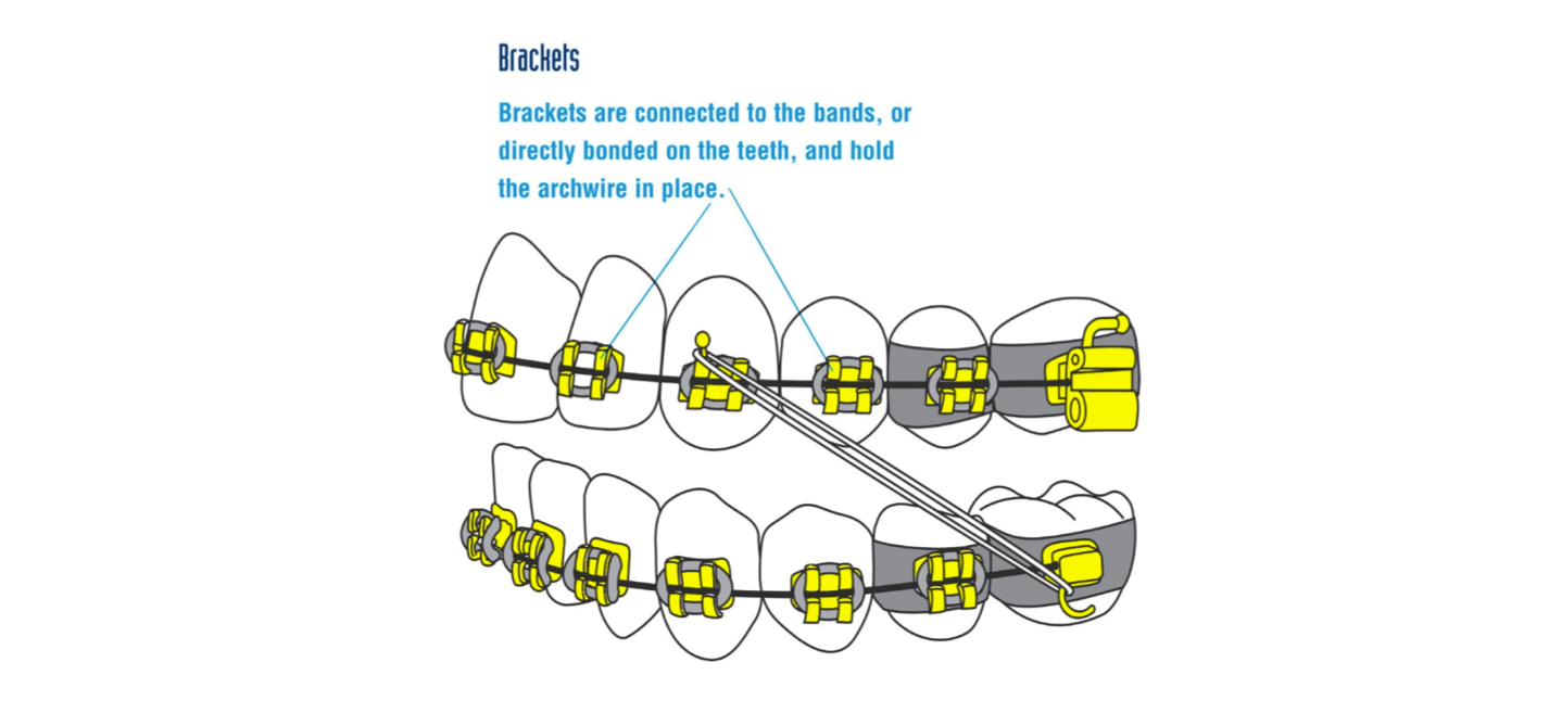 Brackets