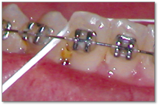 Food stuck in between teeth