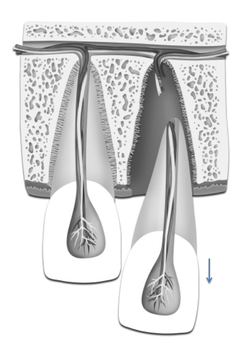 Extruded tooth