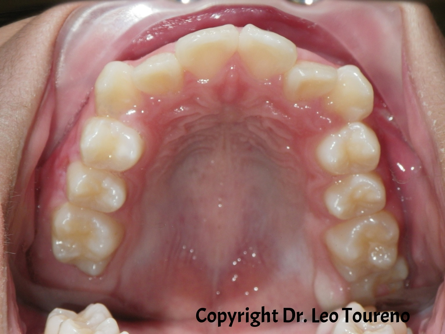 Occlusal Photo of Maxillary Dentition.jpg