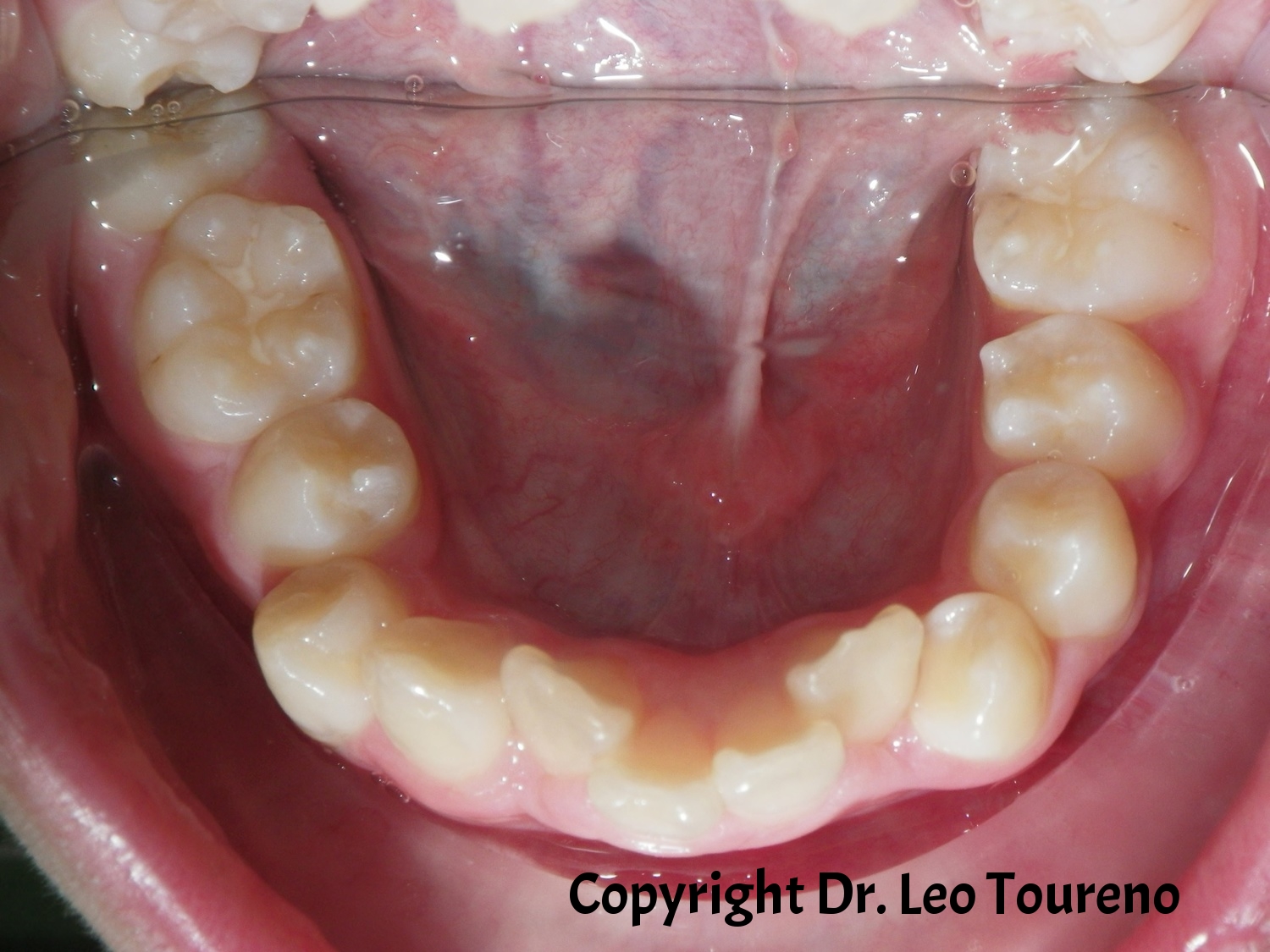 Occlusal Photo of Mandibular Dentition.jpg