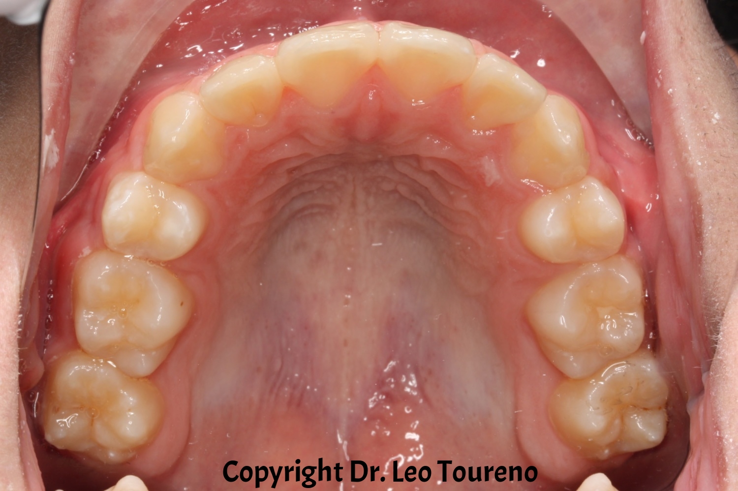 Occlusal Photo of Maxillary Dentition.jpg