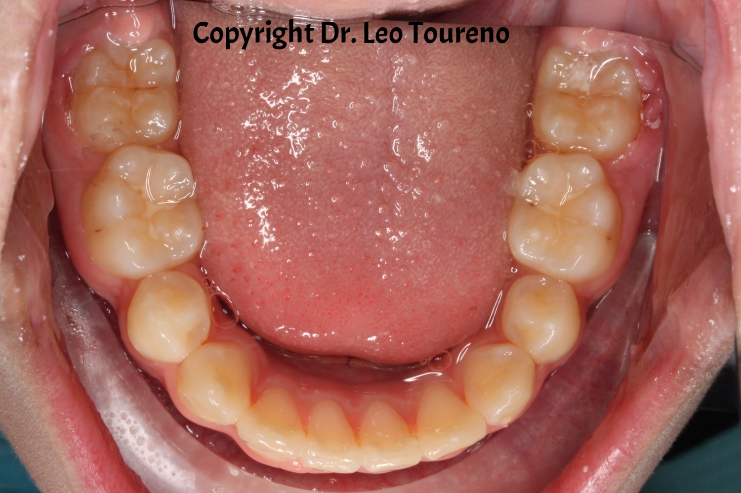 Occlusal Photo of Mandibular Dentition.jpg