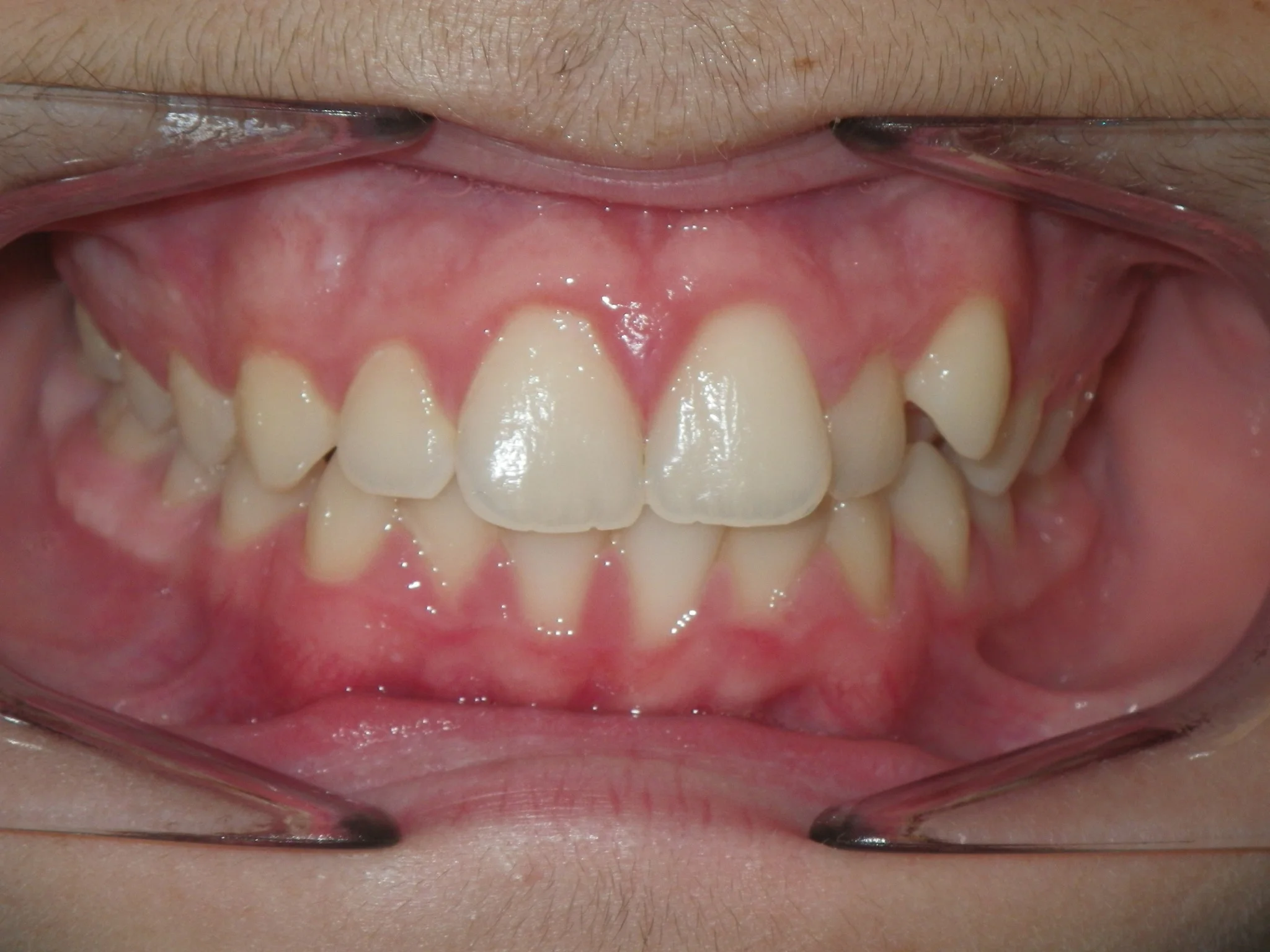 Bite on your back teeth completely and retract your cheeks with your fingers. Take picture of the Front of your Teeth.
