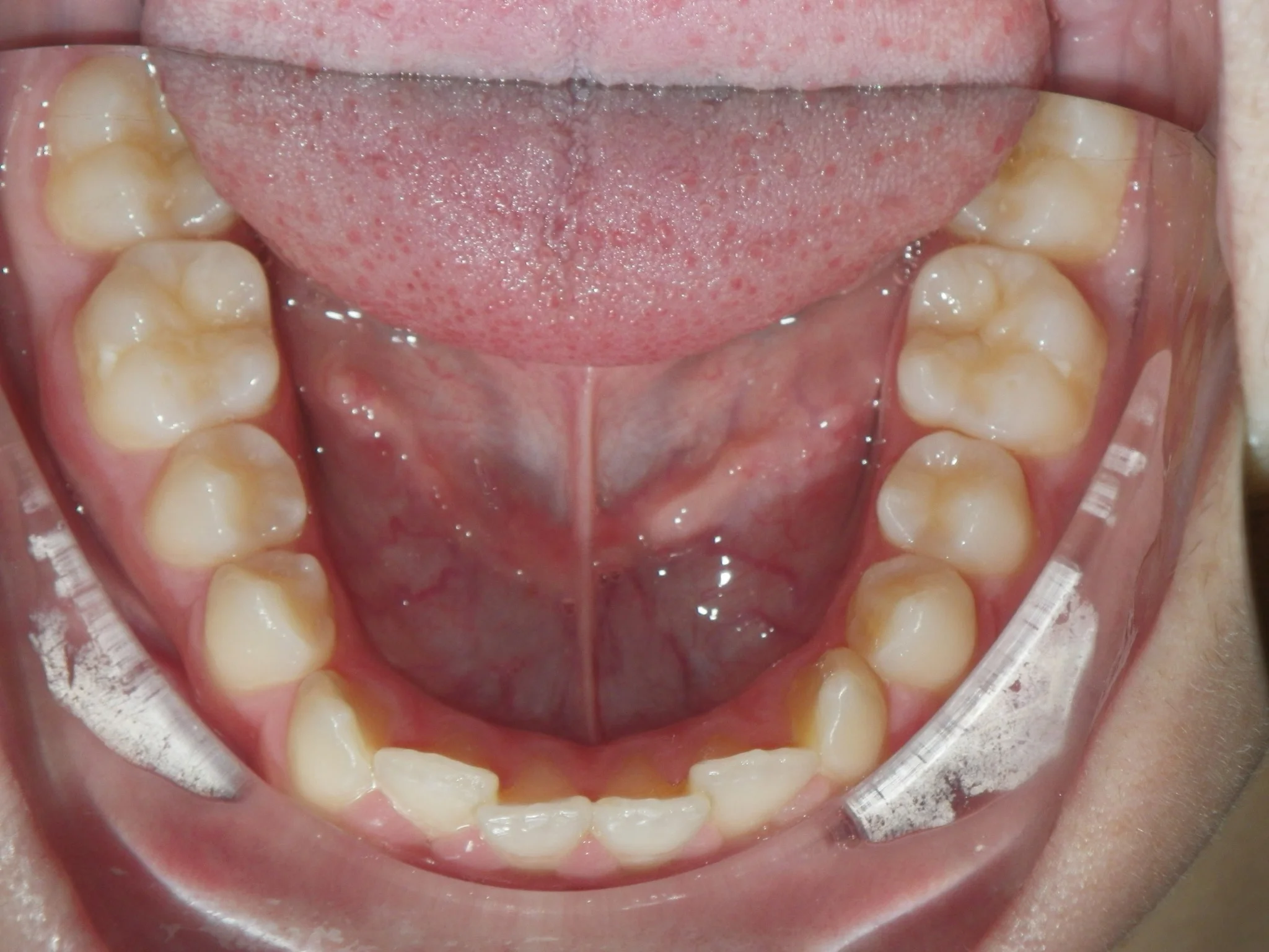 Look down, Open mouth wide and take picture of the Tops of your Lower Teeth. Make sure all teeth are visible and not blurry. Retract your lips as necessary.